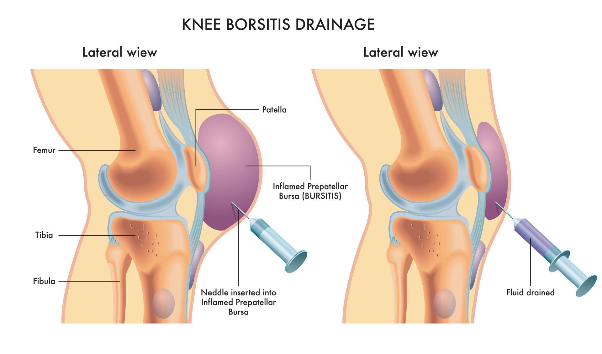 Knee Bursitis Symptoms Diagnosis Treatment Knee Pain Explained Hot My