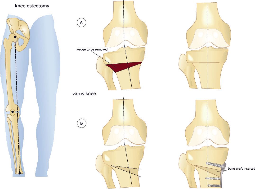 Knee Realignment Osteotomies Dr A Theodorides Knee Surgeon