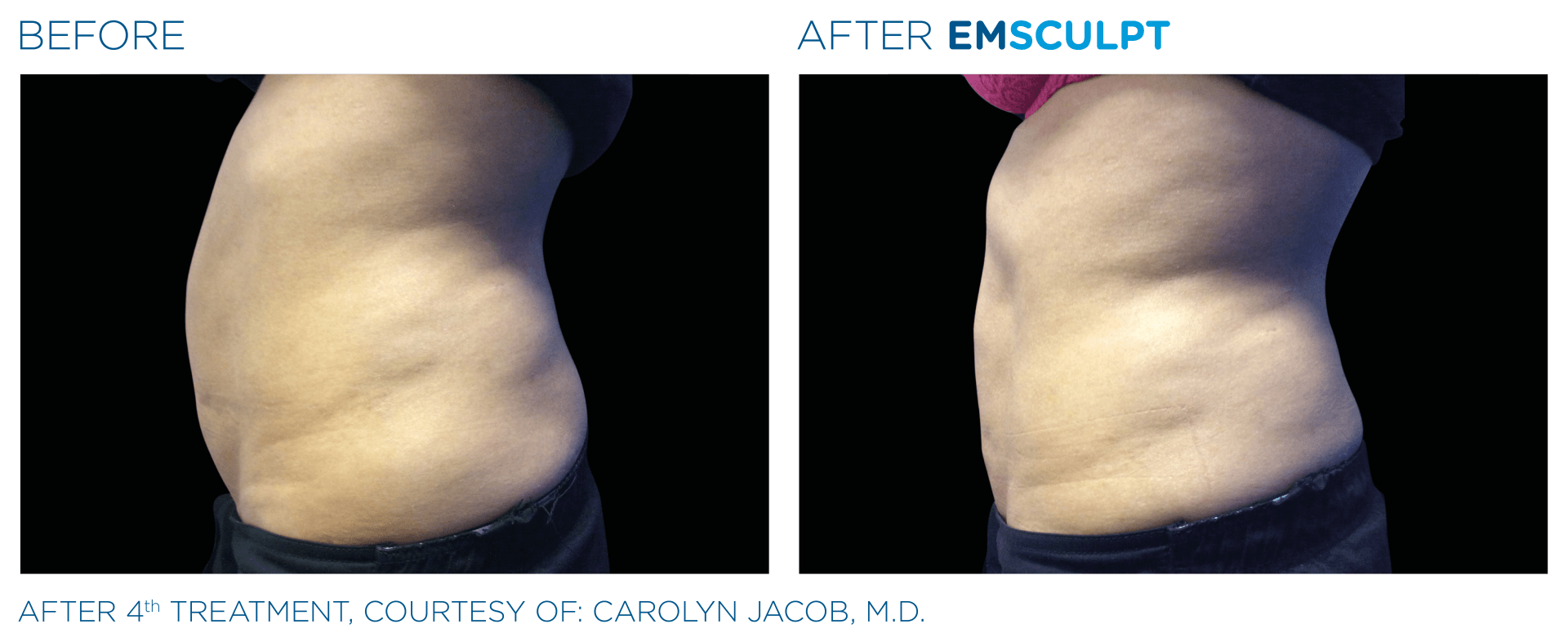 Body Sculpting by EMSCULPT Columbus, OH Columbus EMSCULPT