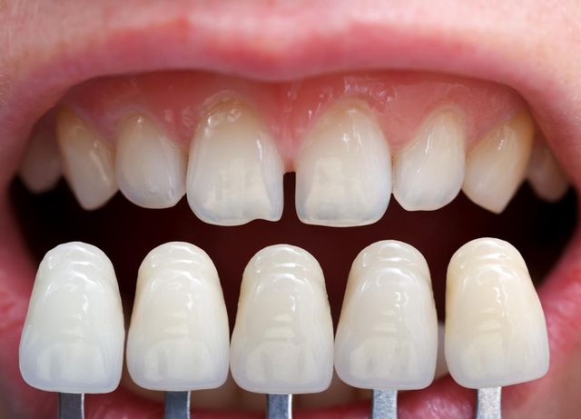 Considering Veneers? Learn The Truth About These Common Misconceptions