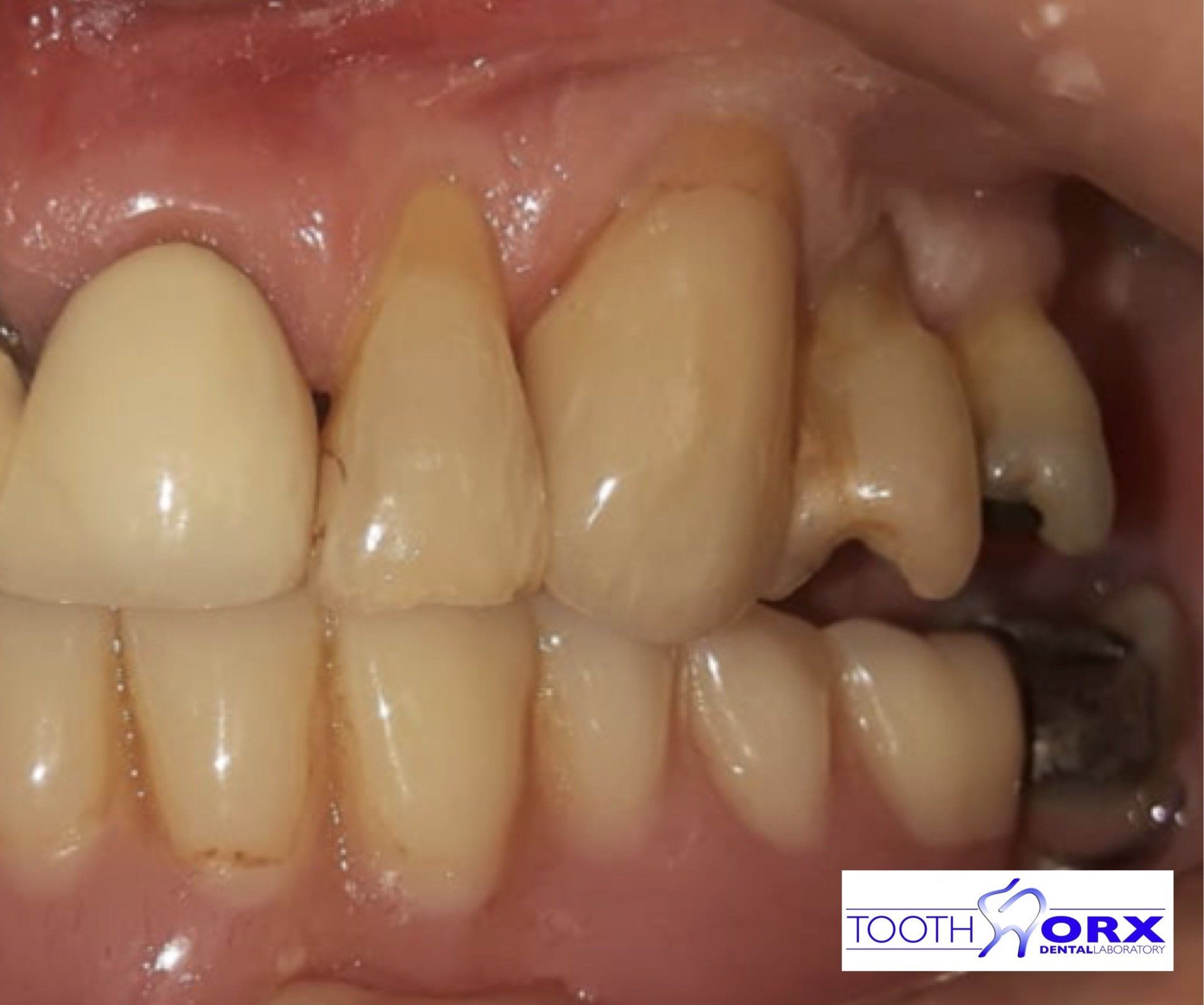 Ivoclar Emax Ceram Layered To Zirconia