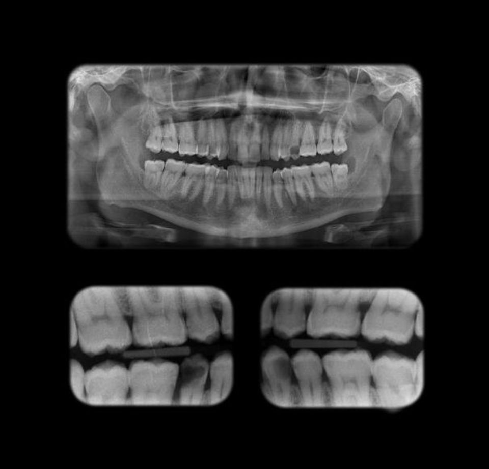 Precisione Artigianale Strumenti Di Estrazione Luxator Per Prestazioni - Foto 9