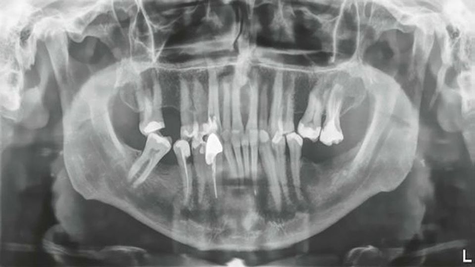 longest-human-tooth-extracted-dr-max-lukas-sets-world-record