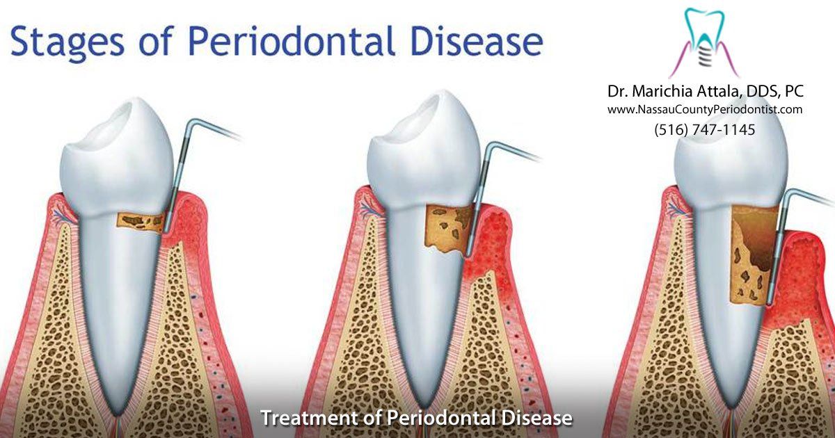 Periodontal Disease Treatment Dr. Marichia Attalla DDS, PC