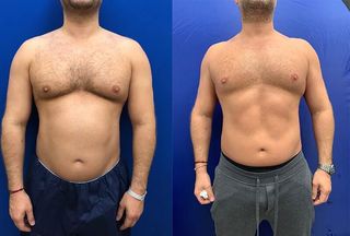 Before & After | Vein & Aesthetic Treatments | Ellicottville, NY | DiMarco