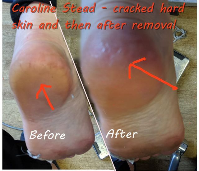 painful cracked heels nhs
