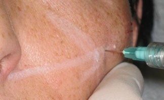 Intervento ringiovanente con filler