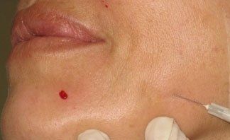 Intervento con acido ialuronico