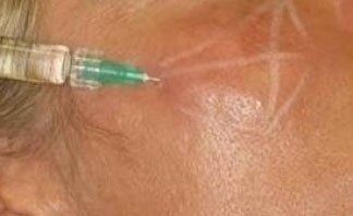 Trattamento con acido ialuronico