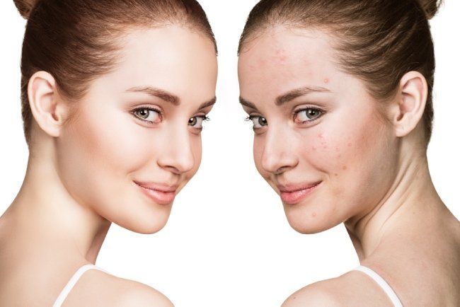 TRATTAMENTO DI MICRONEEDLING