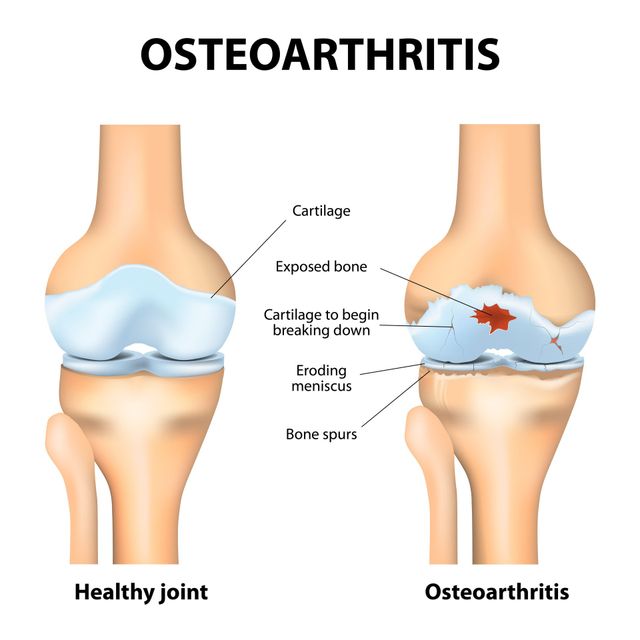 misaligned knee joint