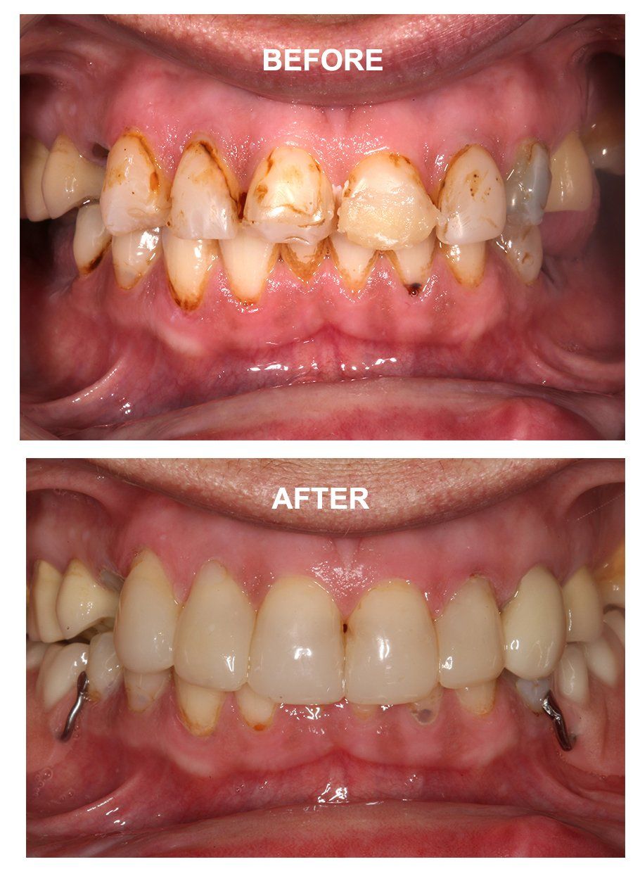 Tooth Bonding Saltash Root Canal Cosmetic Dentist Plymouth