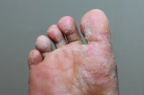 heel athlete's foot
