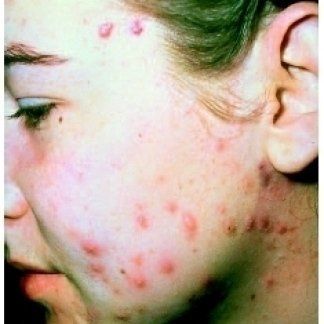 crescita eccessiva di lievito sui sintomi della pelle crescita eccessiva di lievito sui sintomi della pelle