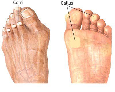 treatment for callus on foot