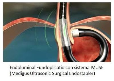 Endoluminal Fundoplicatio con sistema MUSE (Medigus Ultrasonic Surgical Endostapler)