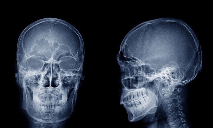 Sleep Apnea Weakens the Skull of Sufferers