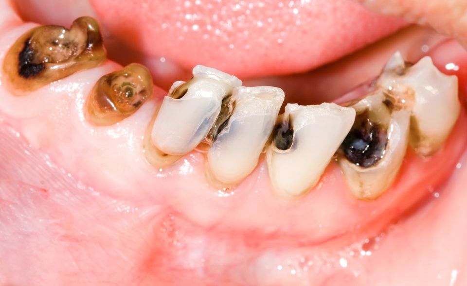 most-common-symptoms-of-tooth-decay