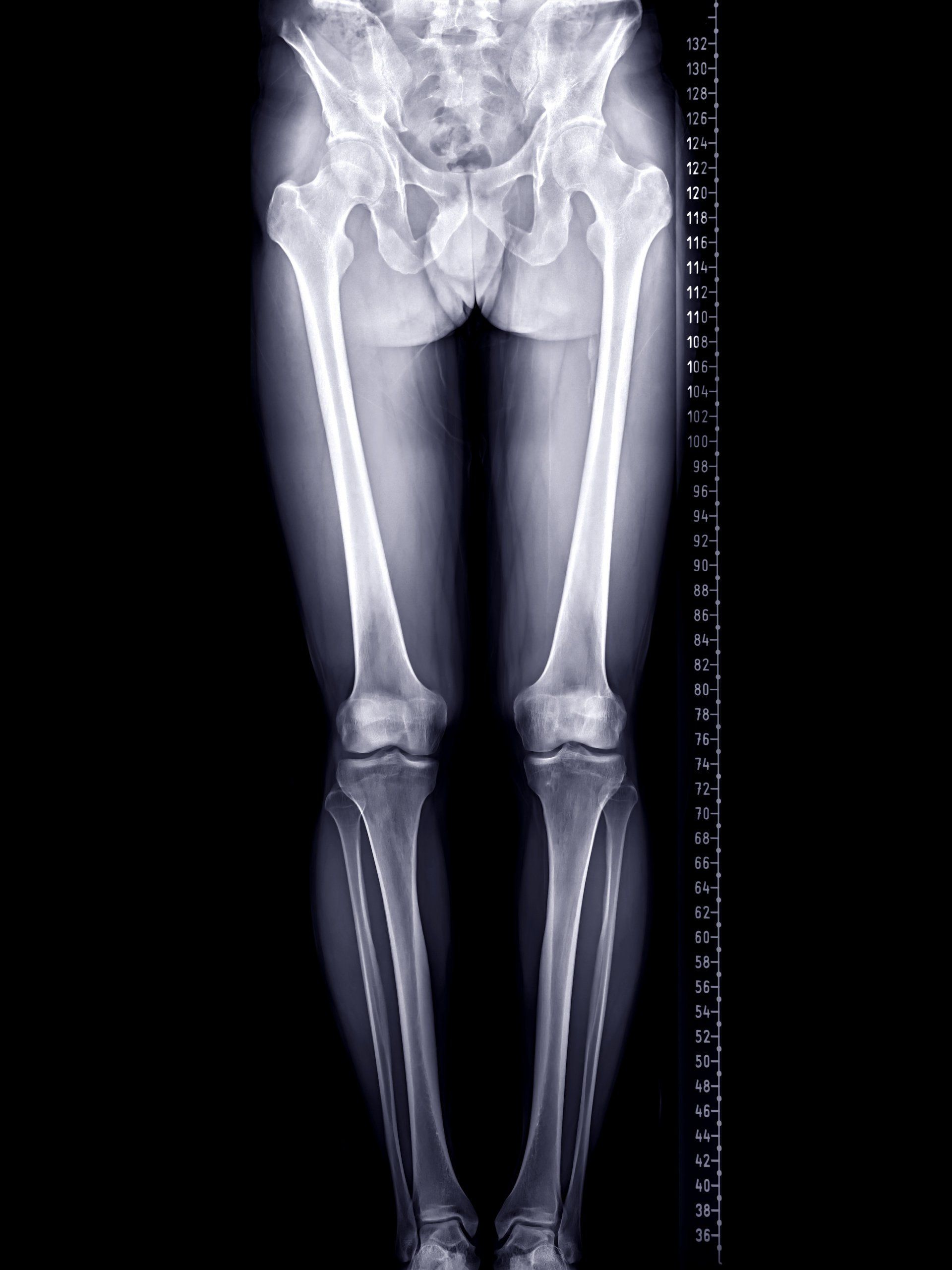 Knee Realignment Osteotomies | Dr A. Theodorides Knee Surgeon
