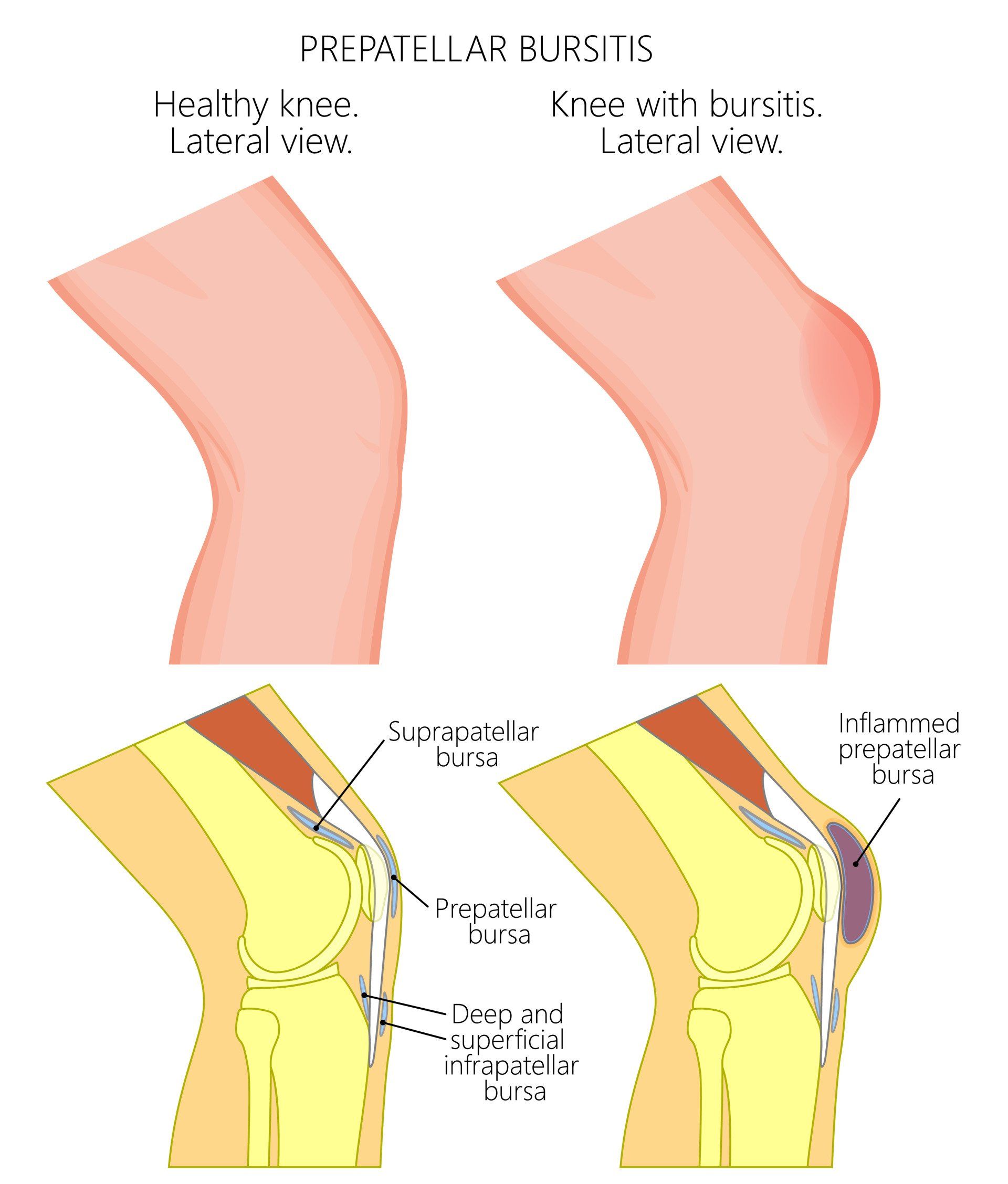 Bursitis Knee Surgeon Dr A Theodorides Symptoms Diagnosis Treatment