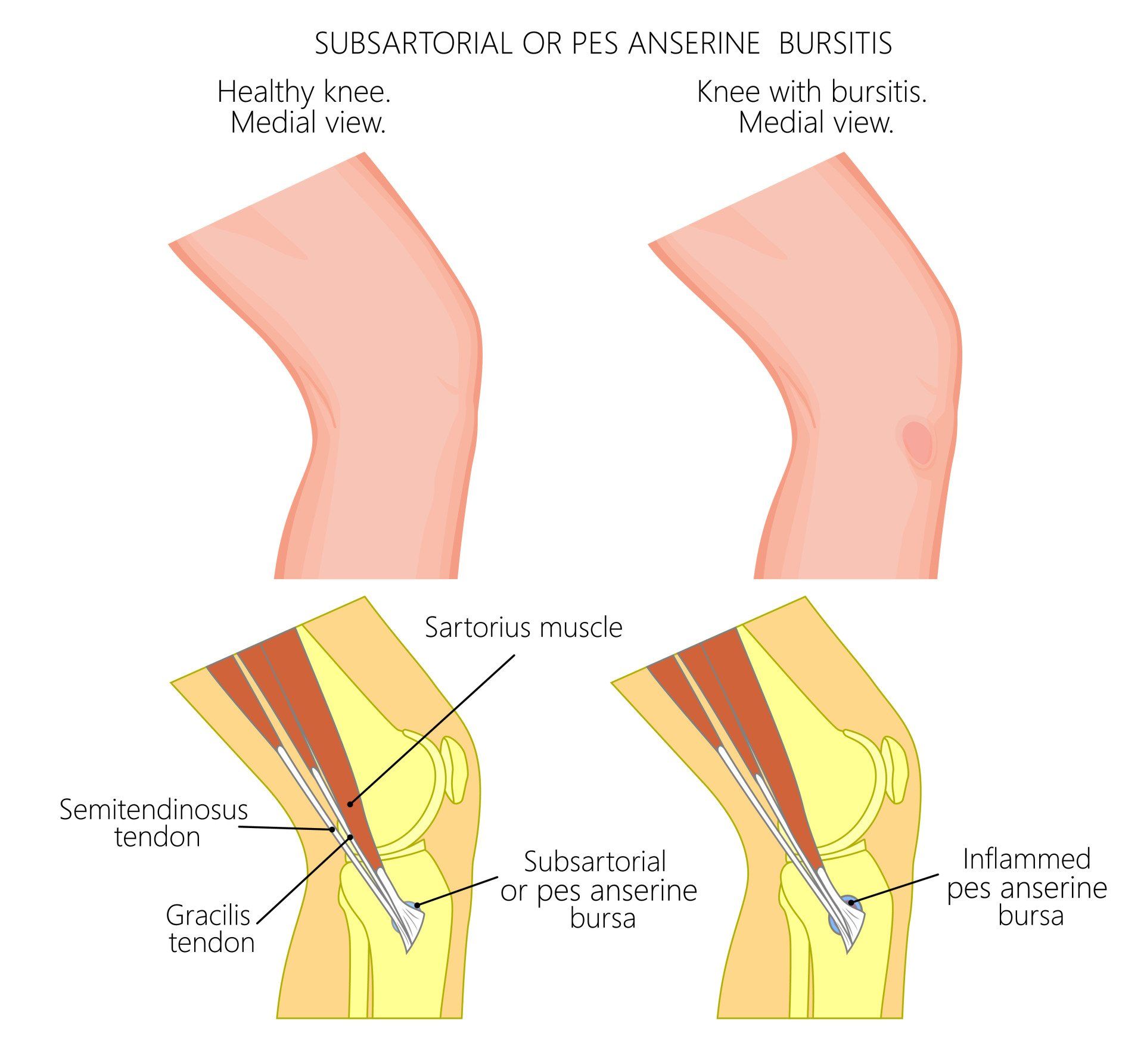 Bursitis Knee Surgeon Dr A Theodorides Symptoms Diagnosis Treatment 9656