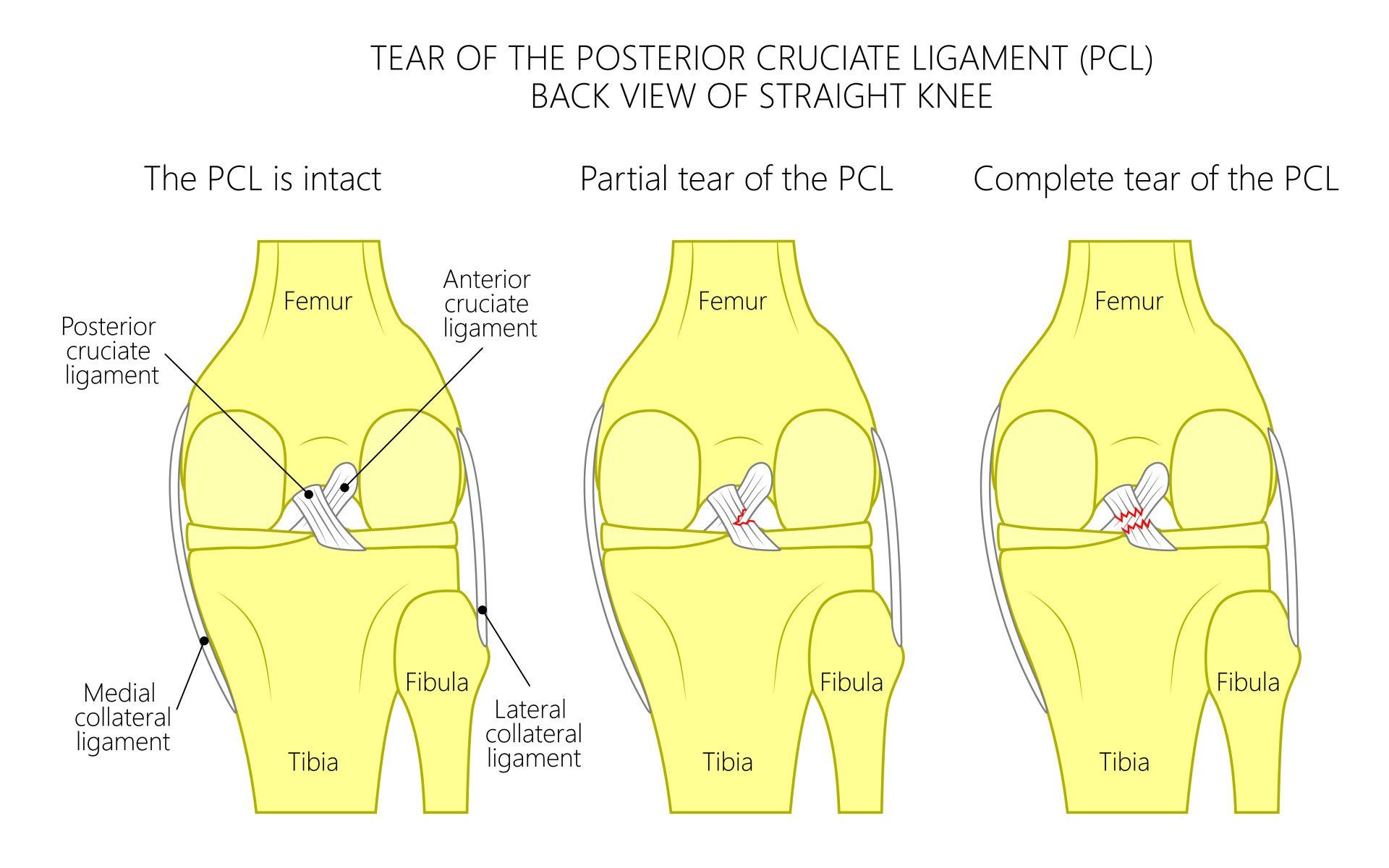 posterior-cruciate-ligament-pcl-injury-symptoms-treatment