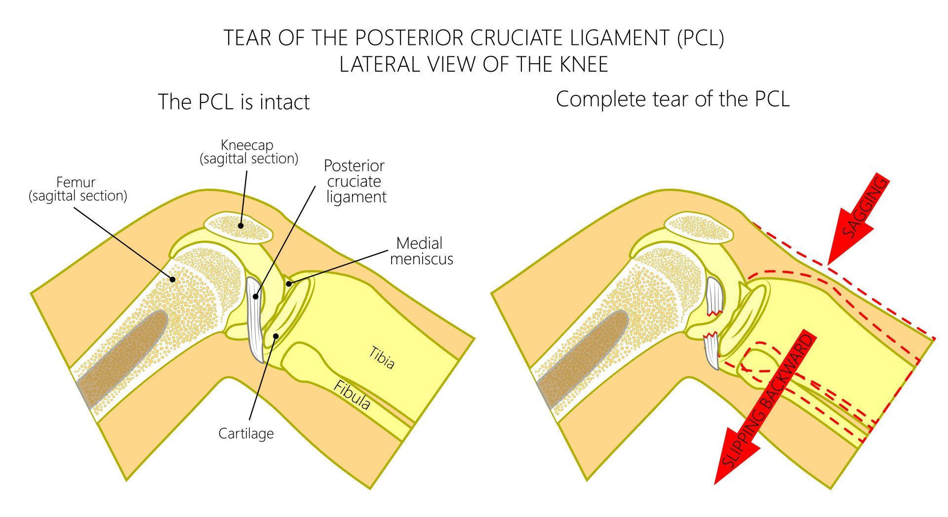 Partial Tear Of The Anterior Cruciate Ligament Icd 10