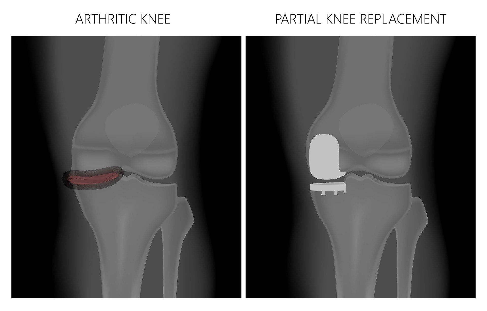 Unicompartmental Knee Replacement Ukr Dr A Theodorides