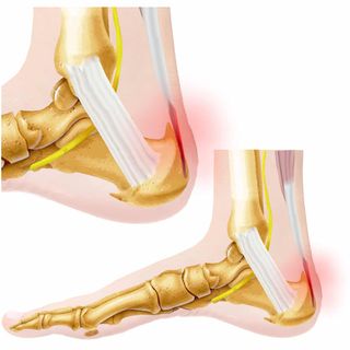 heel spurs and achilles tendonitis