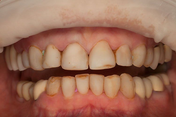 Dantų protezavimas Klaipėda Poc.lt