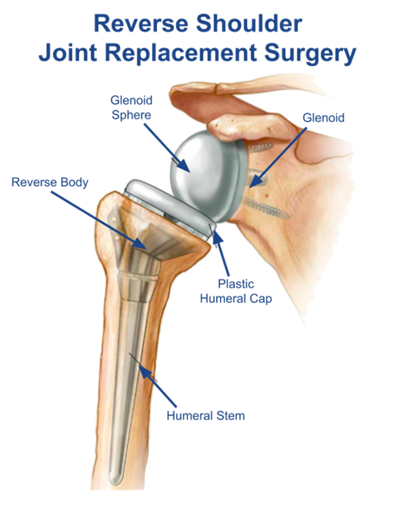 Reverse Total Shoulder Replacement - Bunbury Foot & Ankle Surgeon