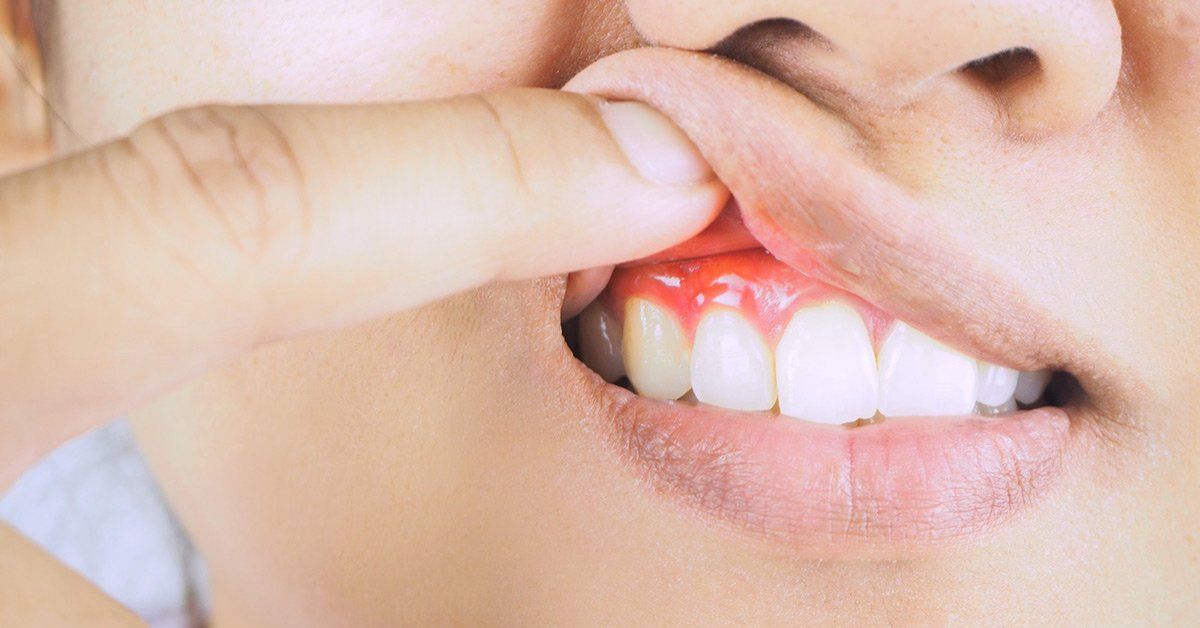 the-different-stages-of-gingivitis-and-gum-disease-explained