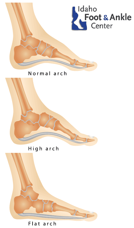 Flexible Flatfoot - Idaho Foot & Ankle Center