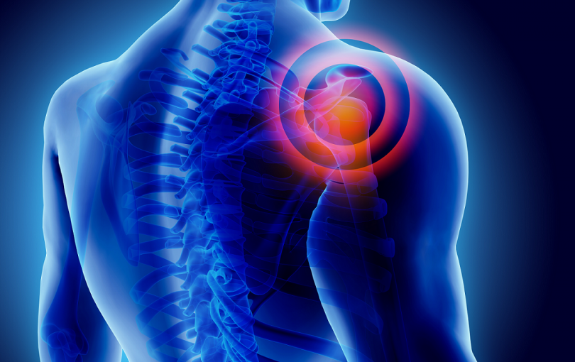 High volume image guided injections in shoulder impingement syndrome