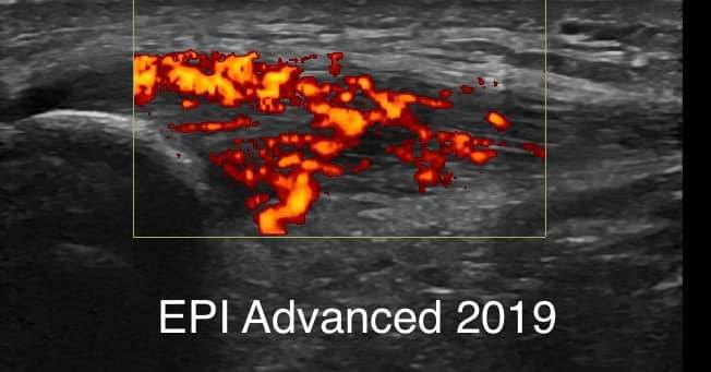 Ecografia de uma tendinopatia rotuliana crónica e neoneurovascular