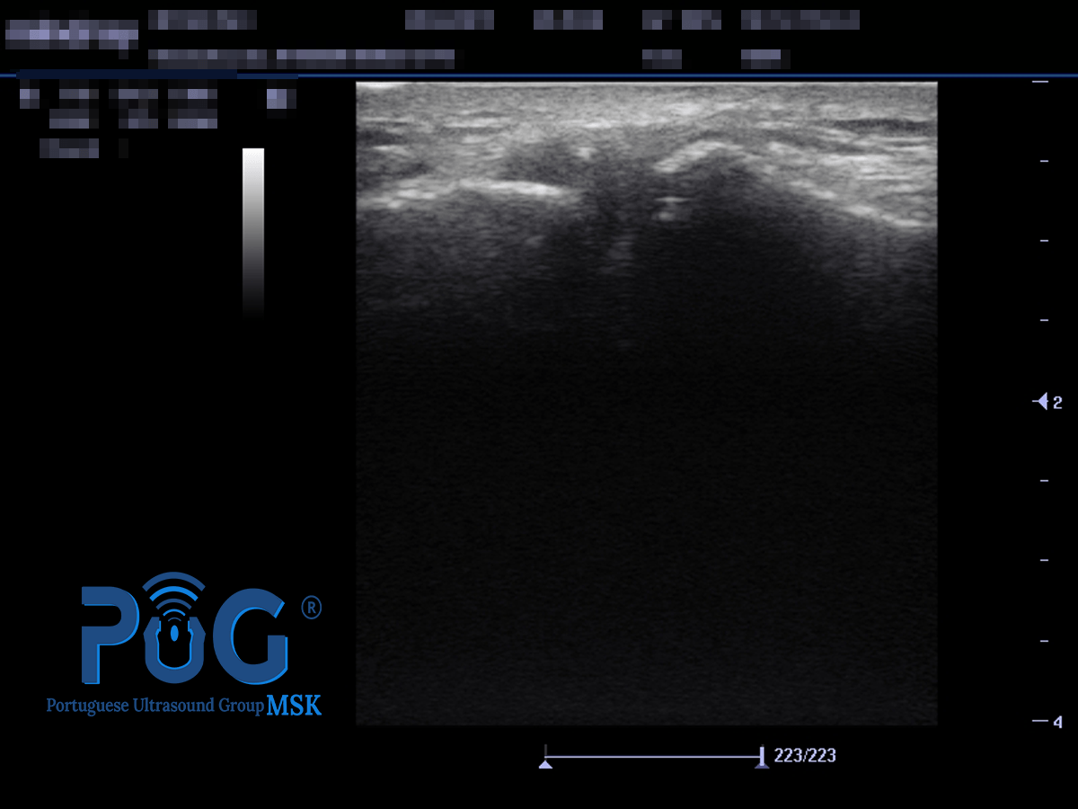 Ecografia de um omalgia que teve origem na articulação acrómio-clavicular (AC)