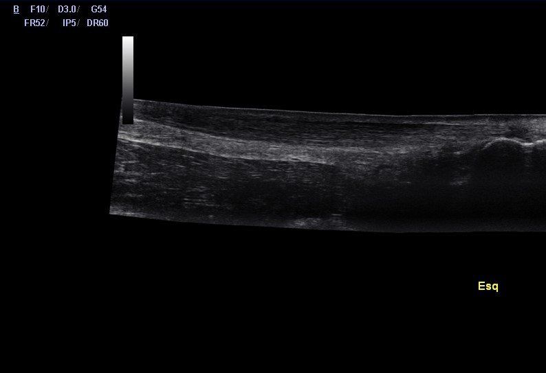 Imagem ecográfica de uma tendinopatia.