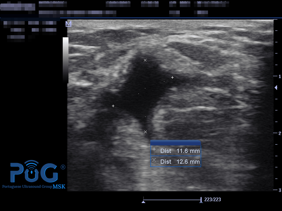 Optimização da regeneração após lesão muscular, mediante a aplicação da técnica EPI®