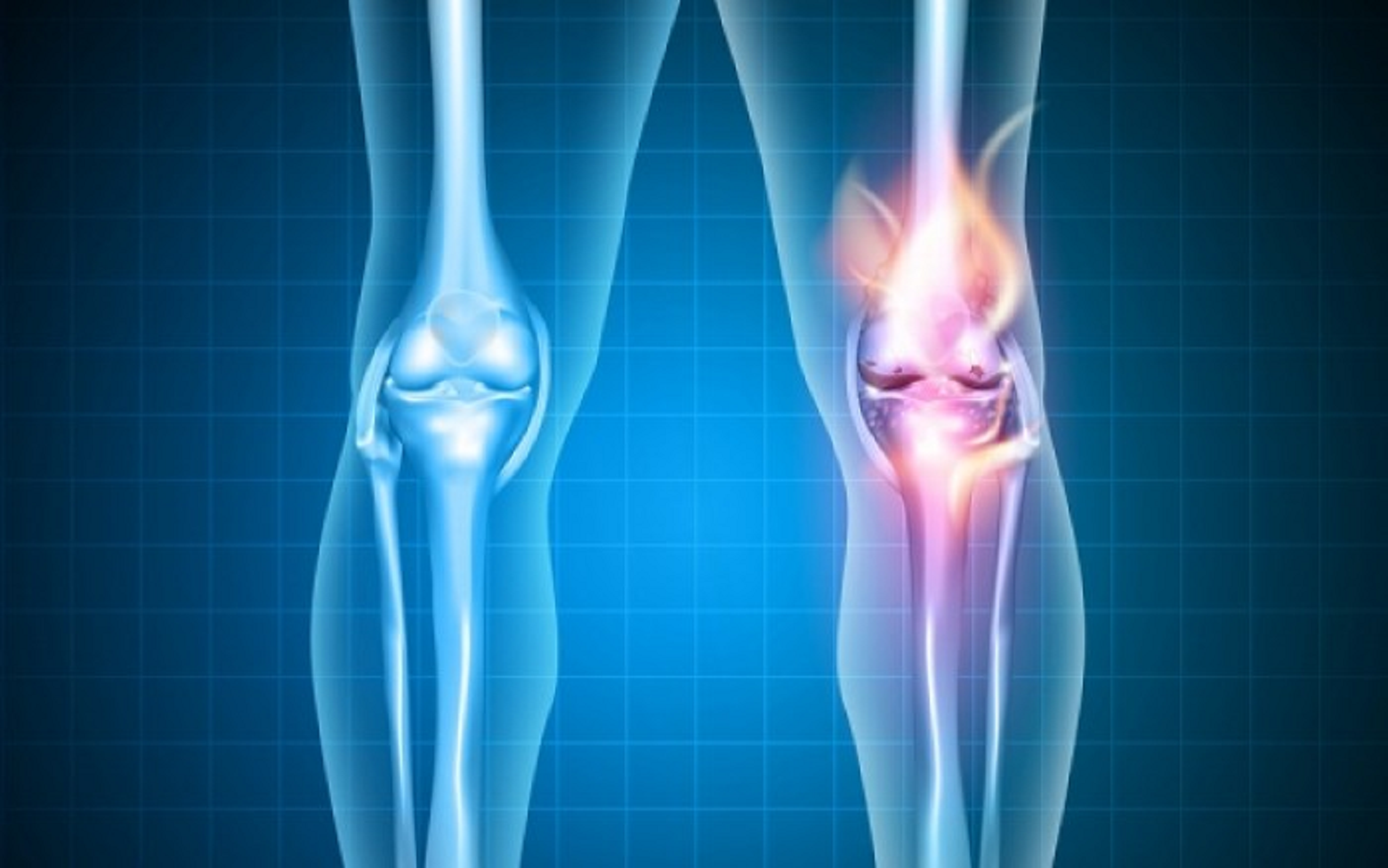 Platelet-rich plasma, hyaluronic acid or ozone in treatment of knee osteoarthritis