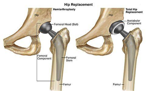 physical-therapist-s-guide-to-total-hip-replacement-arthroplasty