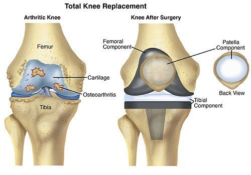 Physical Therapist S Guide To Total Knee Replacement Arthroplasty