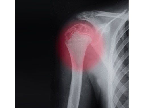 humerus fracture