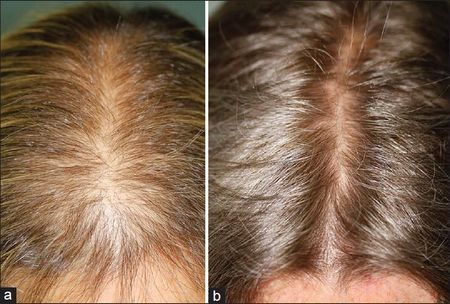 Hair Restoration - Olympia, WA - Natural Healing Family Medicine