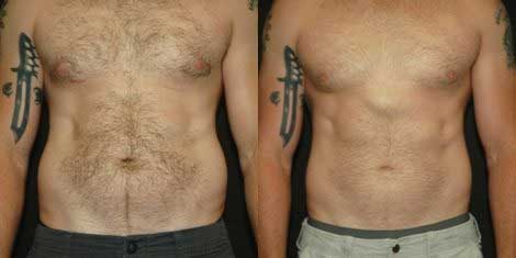 Non-Surgical Laser Lipo Treatments in Libertyville, IL