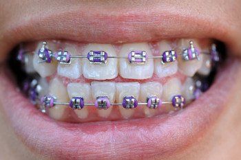 self teeth straightening