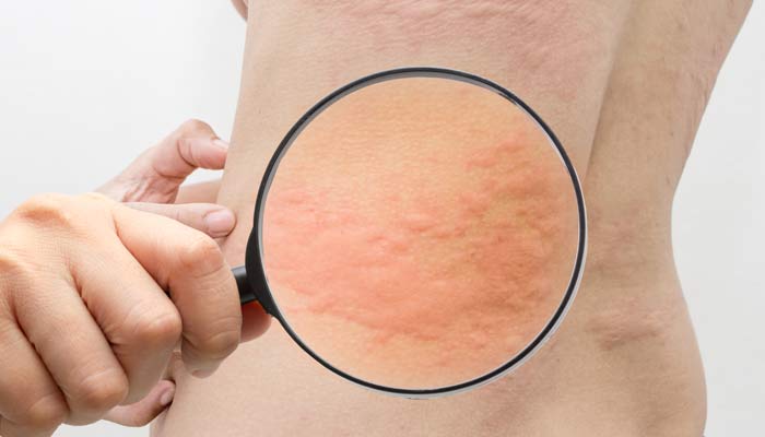 Relief from Allergies in NYC