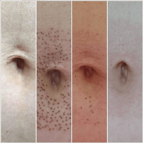 Fibroblast Plasma Skin Tightening