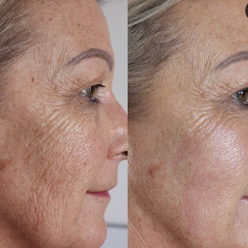 Fibroblast Plasma Skin Tightening