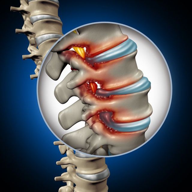 Brooksville Back Pain