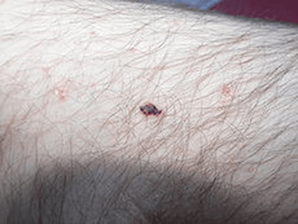 Dr Flora Skin Health  Cherry Angioma Treatment